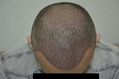 DR HAKAN DOGANAY FUE HAIR TRANSPLANT8.jpg
