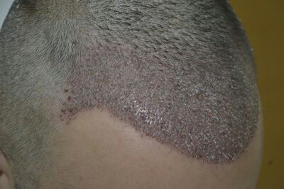 DR HAKAN DOGANAY FUE HAIR TRANSPLANT9.jpg
