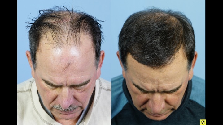Dr Josephitis hair transplant result 2.jpg