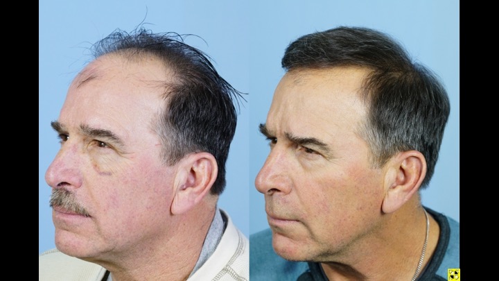 Dr Josephitis hair transplant result 3.jpg