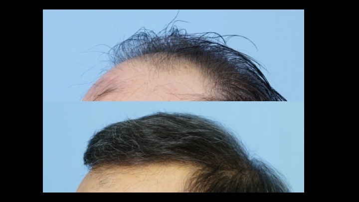 Dr Josephitis hair transplant result 4.jpg
