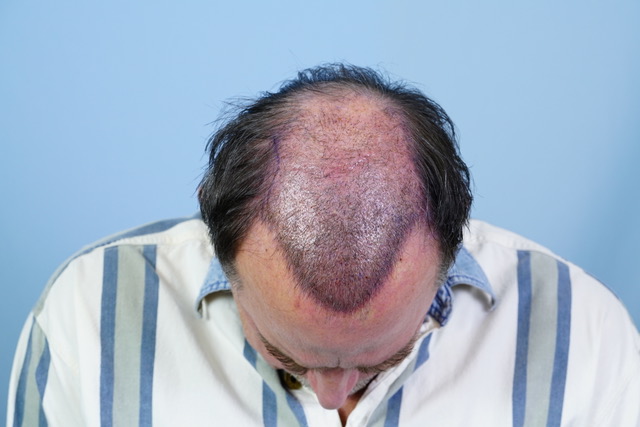 Dr Josephitis hair transplant result 5.jpeg