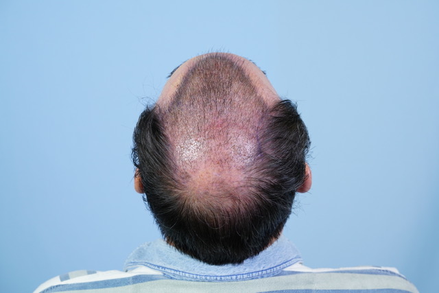 Dr Josephitis hair transplant result 6.jpeg
