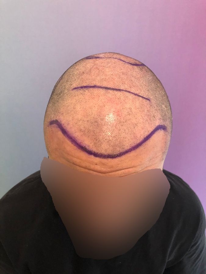 Dr Ozlem Bicer Hair Transplant.jpg