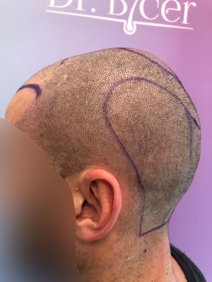 Dr Ozlem Bicer Hair Transplant1.jpg