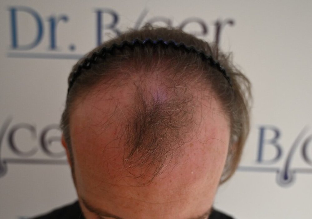 Dr Ozlem Bicer Hair Transplant1.jpg
