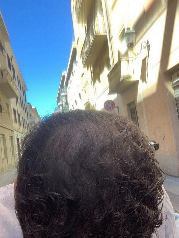 Dr Ozlem Bicer Hair Transplant10.jpg