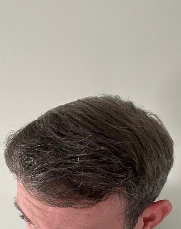 Dr Ozlem Bicer Hair Transplant10.jpg