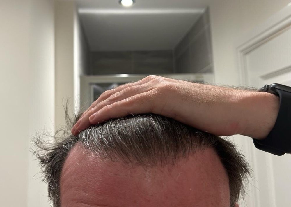 Dr Ozlem Bicer Hair Transplant11.jpg