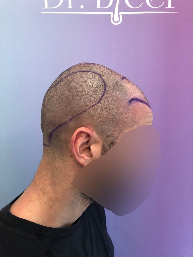 Dr Ozlem Bicer Hair Transplant2.jpg