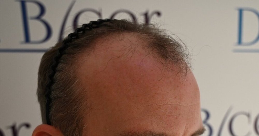 Dr Ozlem Bicer Hair Transplant2.jpg