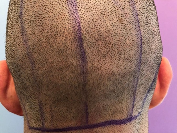 Dr Ozlem Bicer Hair Transplant3.jpg