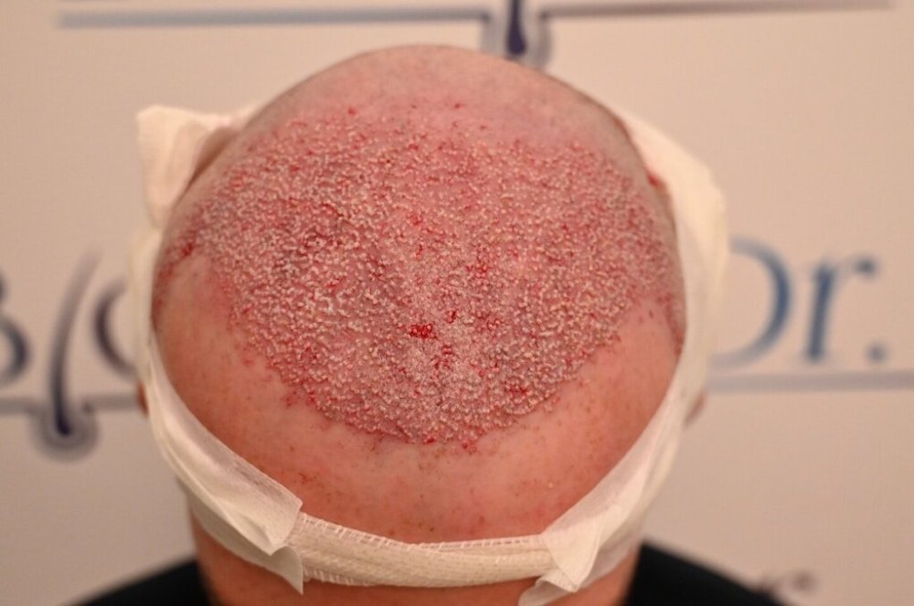 Dr Ozlem Bicer Hair Transplant3.jpg