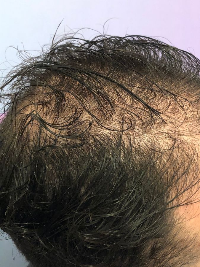 Dr Ozlem Bicer Hair Transplant4.jpg