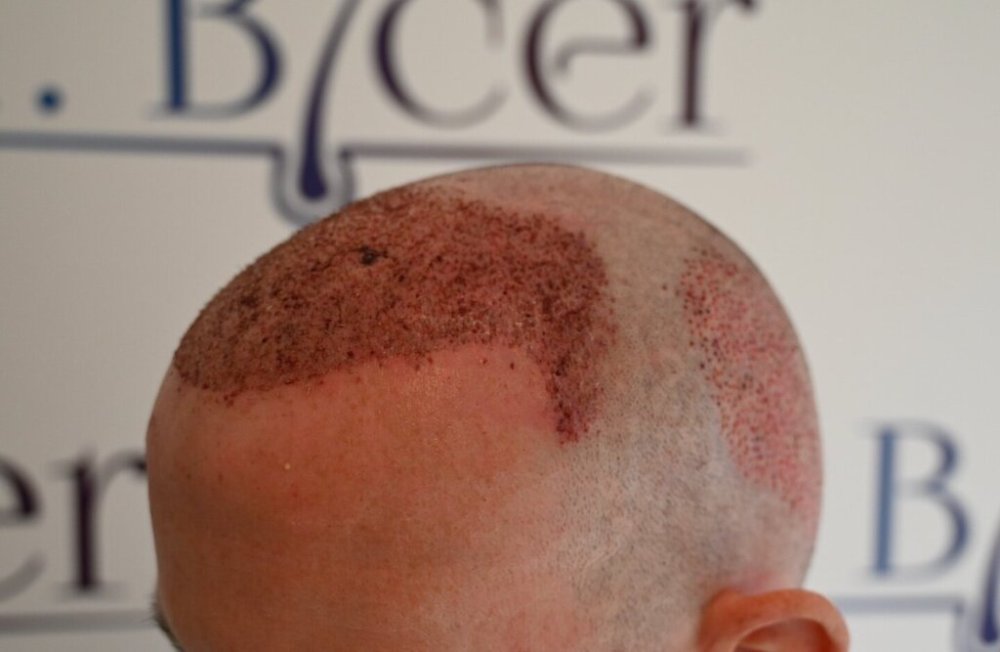 Dr Ozlem Bicer Hair Transplant4.jpg