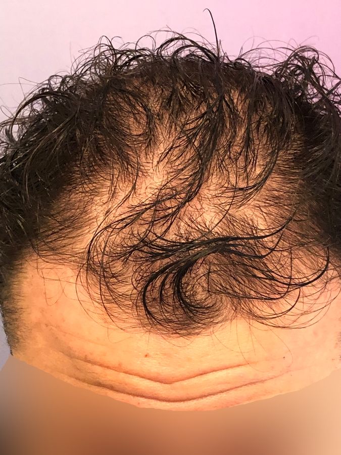Dr Ozlem Bicer Hair Transplant5.jpg