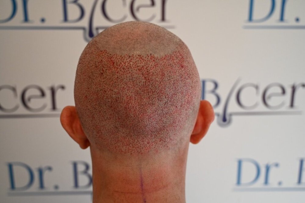 Dr Ozlem Bicer Hair Transplant5.jpg