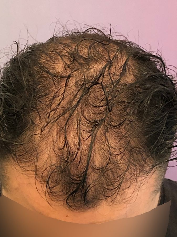 Dr Ozlem Bicer Hair Transplant6.jpg