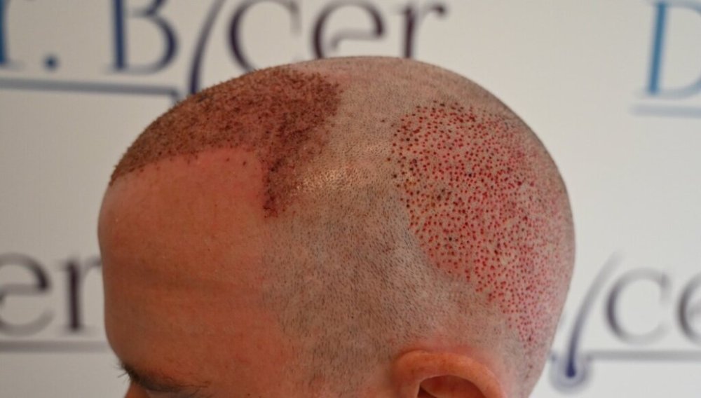 Dr Ozlem Bicer Hair Transplant6.jpg