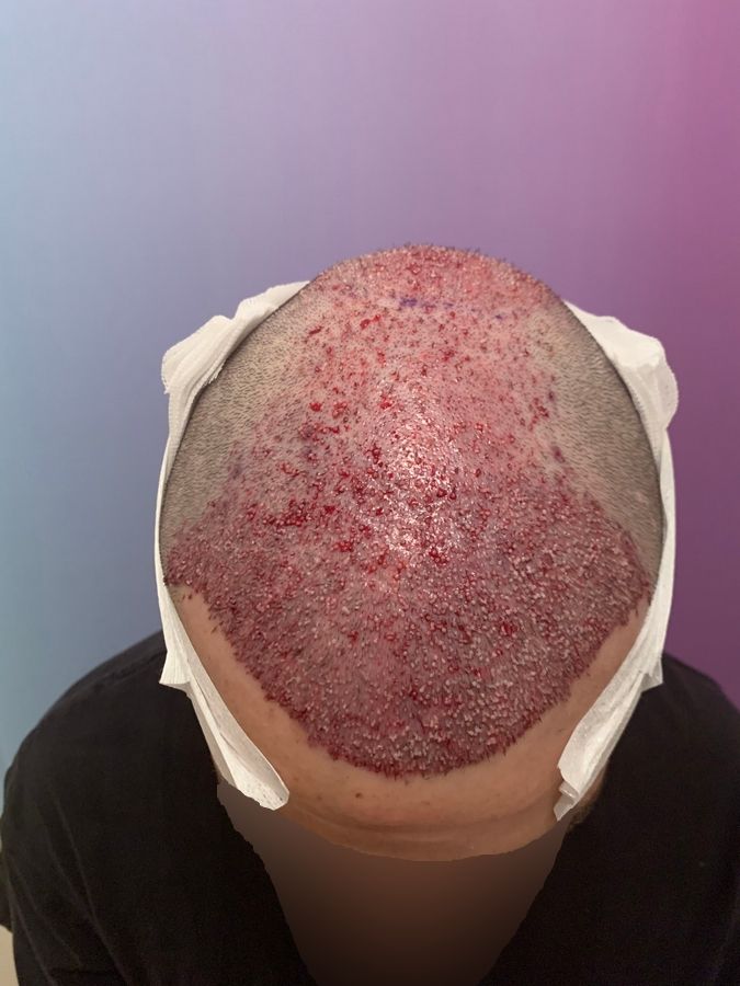 Dr Ozlem Bicer Hair Transplant7.jpg