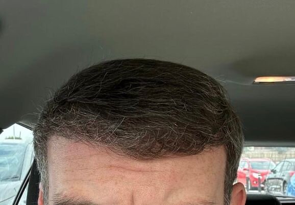 Dr Ozlem Bicer Hair Transplant7.jpg