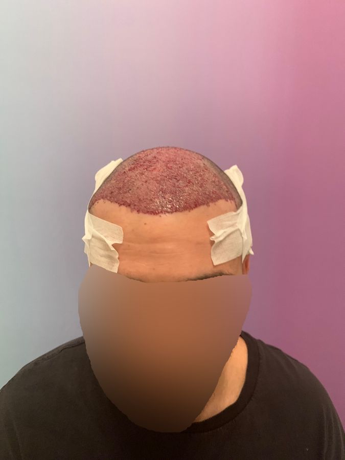 Dr Ozlem Bicer Hair Transplant8.jpg