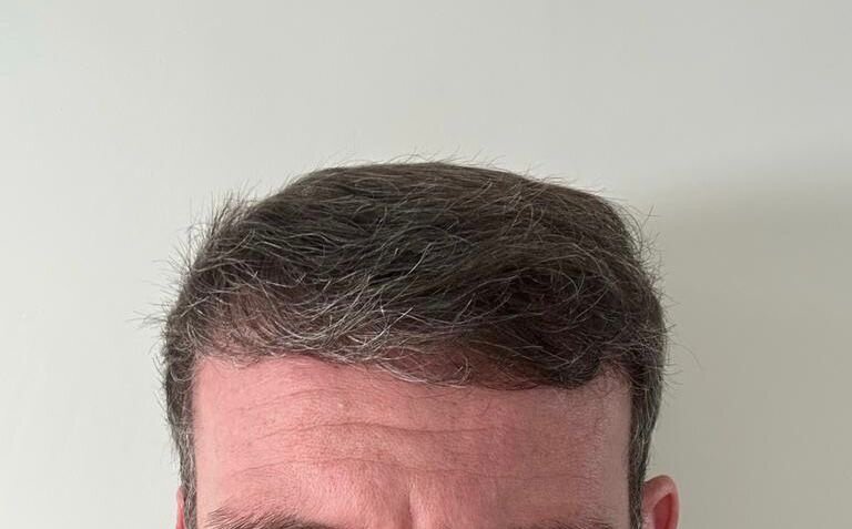 Dr Ozlem Bicer Hair Transplant8.jpg