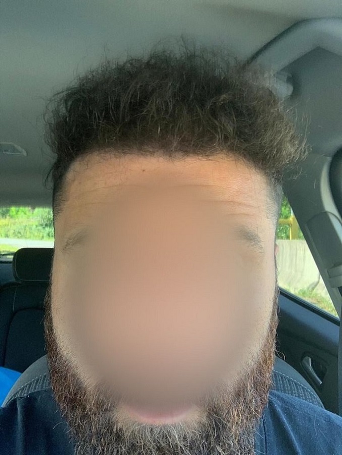Dr Ozlem Bicer Hair Transplant9.jpg