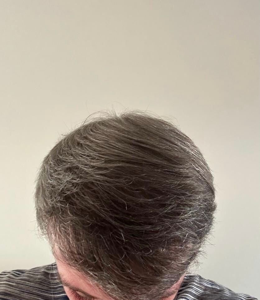 Dr Ozlem Bicer Hair Transplant9.jpg