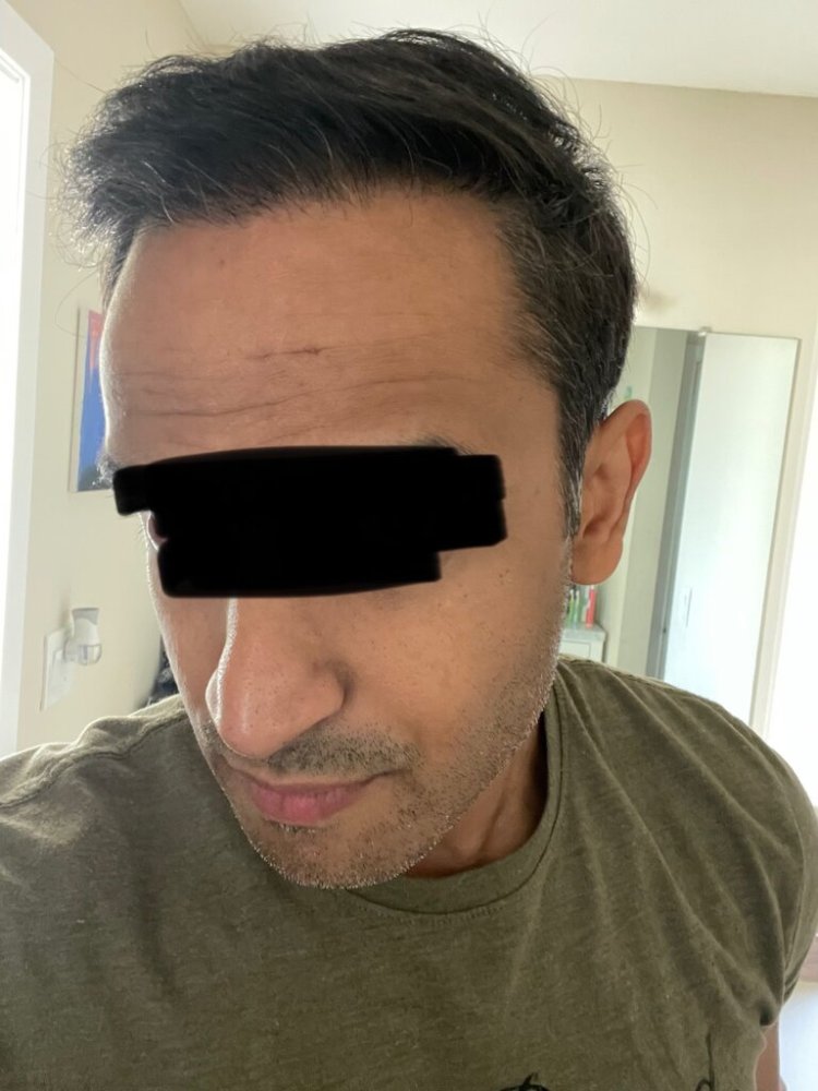 Dr. Ron Shapiro 8.5 months post-op hair transplant1.jpeg