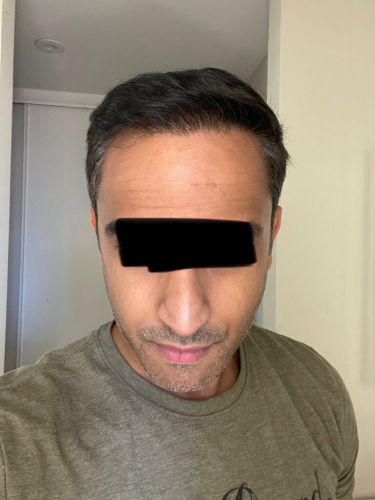 Dr. Ron Shapiro 8.5 months post-op hair transplant2.jpeg
