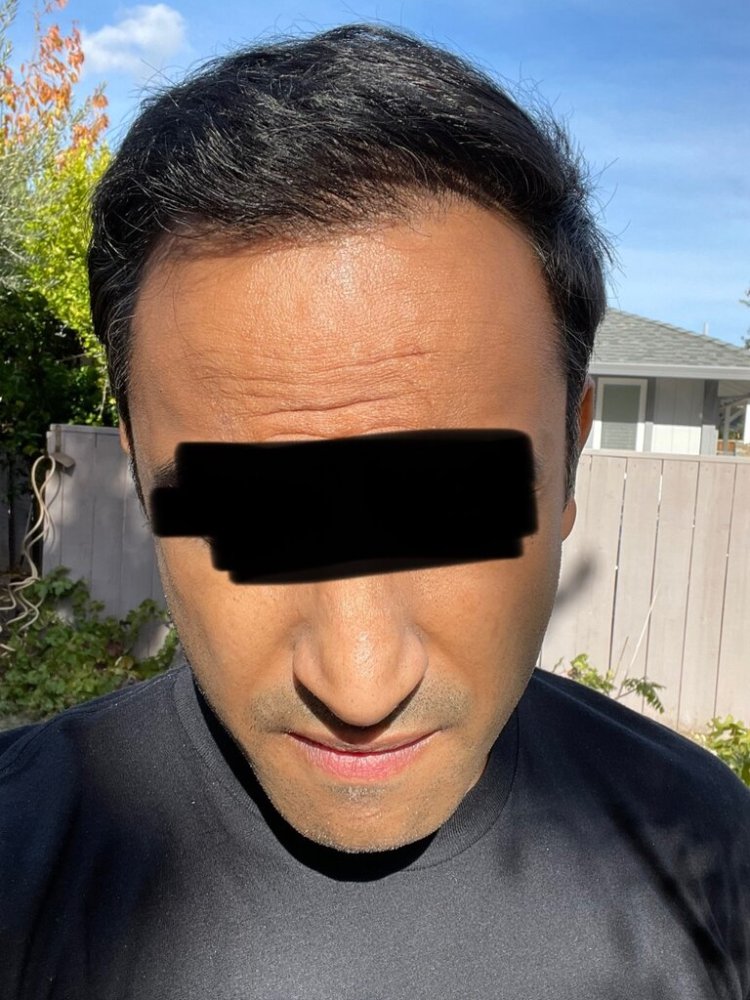 Dr. Ron Shapiro 8.5 months post-op hair transplant4.jpeg