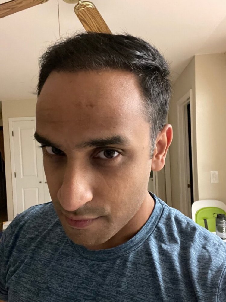 Dr. Ron Shapiro hair transplant 6 months1.jpeg