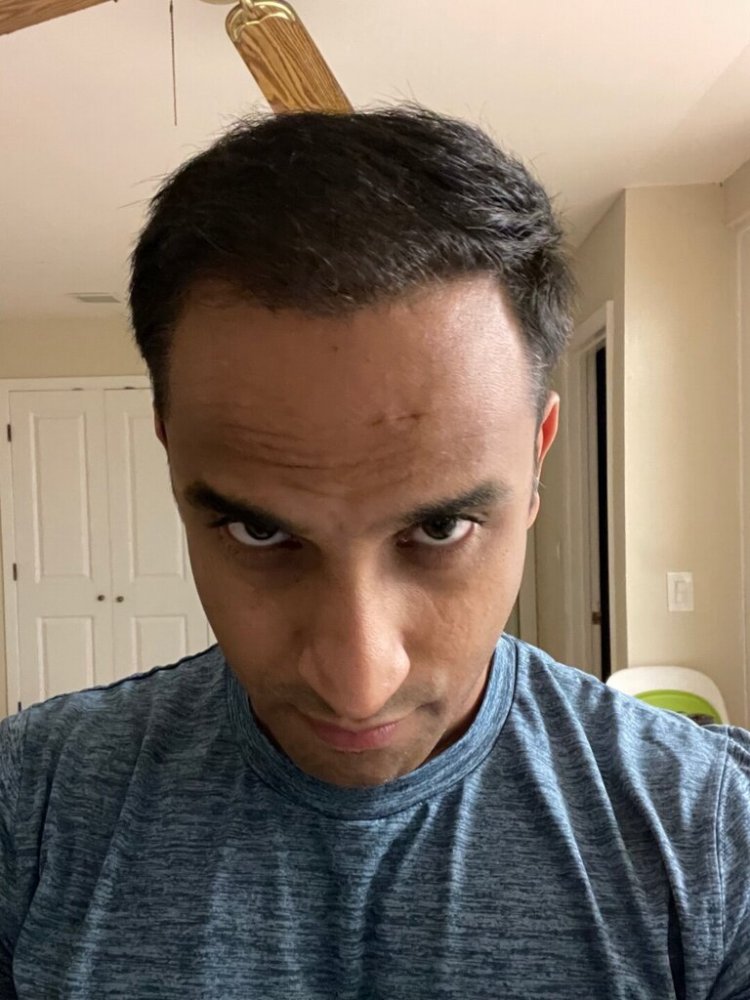 Dr. Ron Shapiro hair transplant 6 months2.jpeg