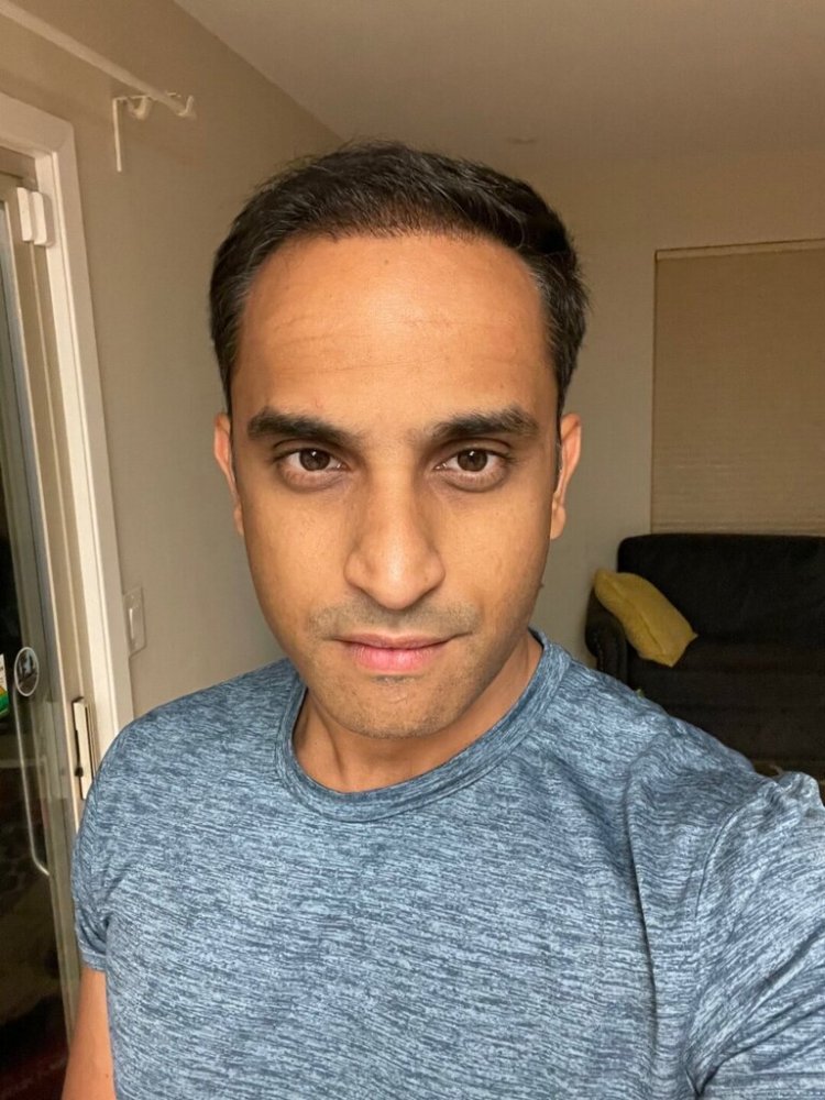 Dr. Ron Shapiro hair transplant 6 months4.jpeg