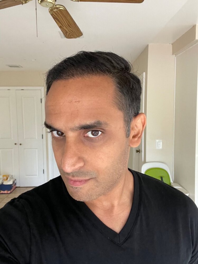Dr. Ron Shapiro hair transplant 6 months5.jpeg