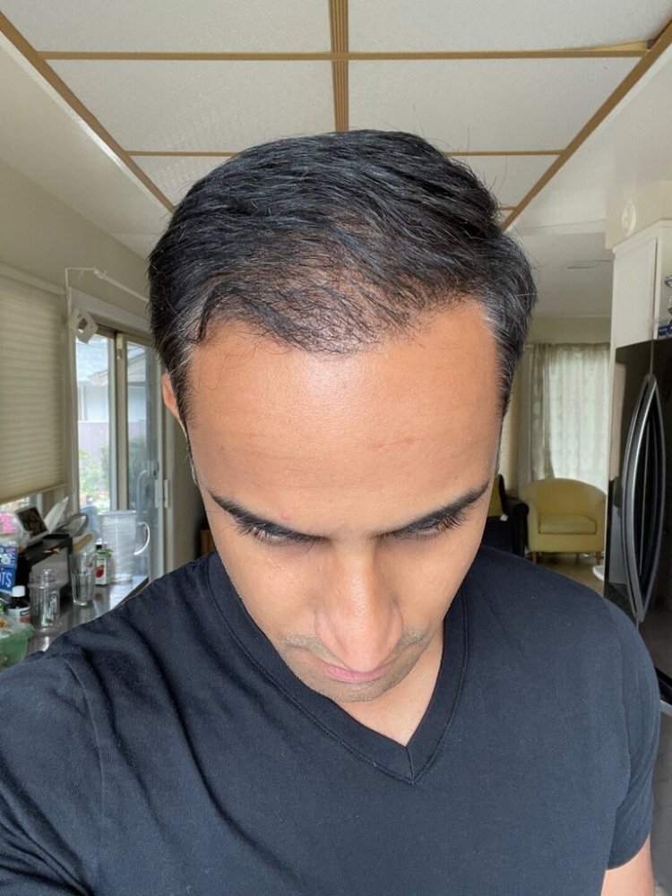 Dr. Ron Shapiro hair transplant 6 months6.jpeg
