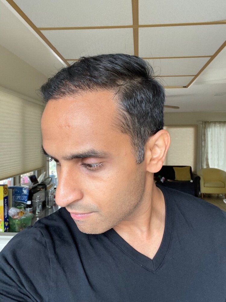 Dr. Ron Shapiro hair transplant 6 months7.jpeg