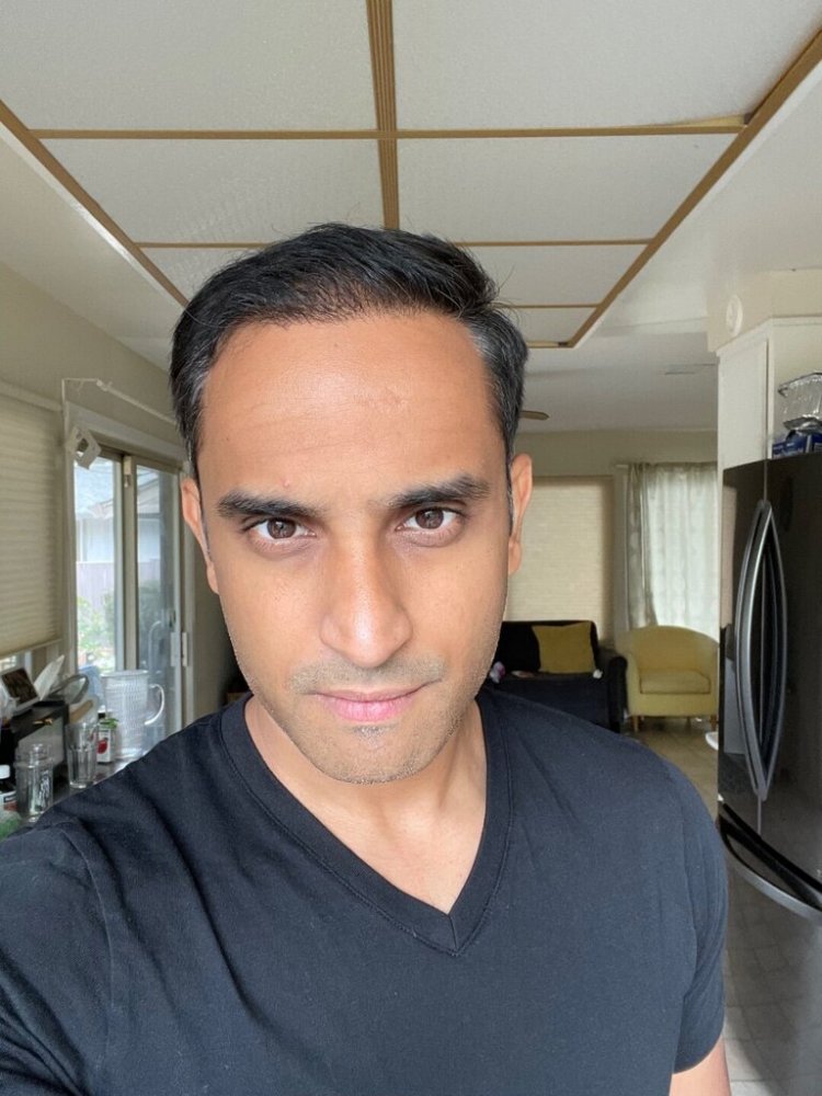 Dr. Ron Shapiro hair transplant 6 months8.jpeg