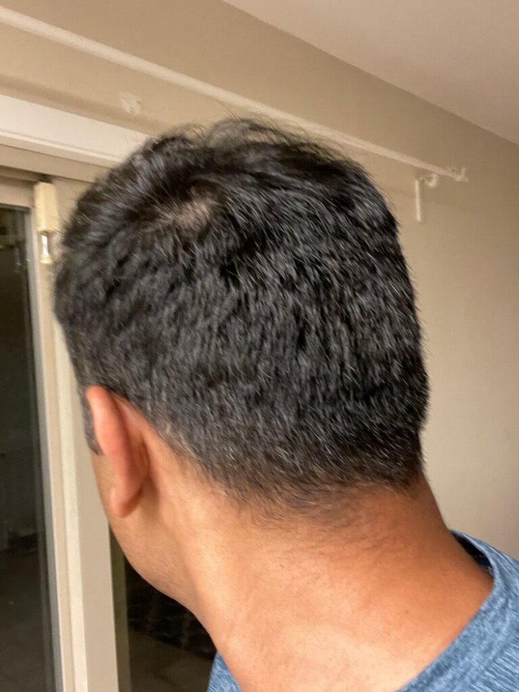Dr. Ron Shapiro hair transplant 6 months9.jpeg