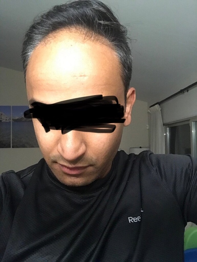 Dr. Ron Shapiro Hair Transplant1.jpeg