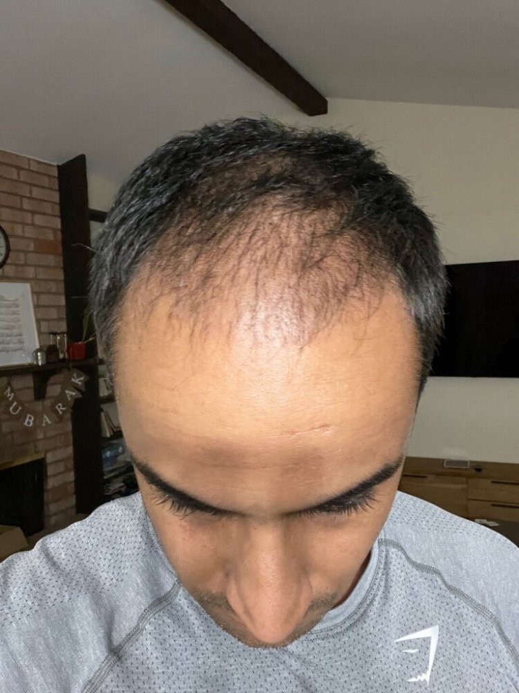 Dr. Ron Shapiro hair transplant1.jpeg