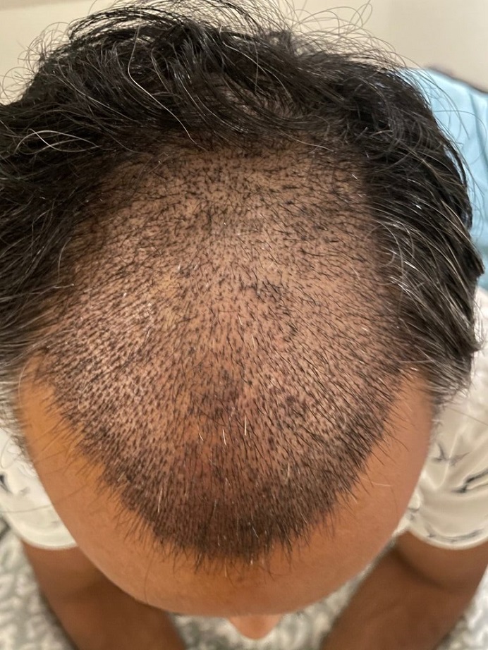 Dr. Ron Shapiro Hair Transplant10.jpeg