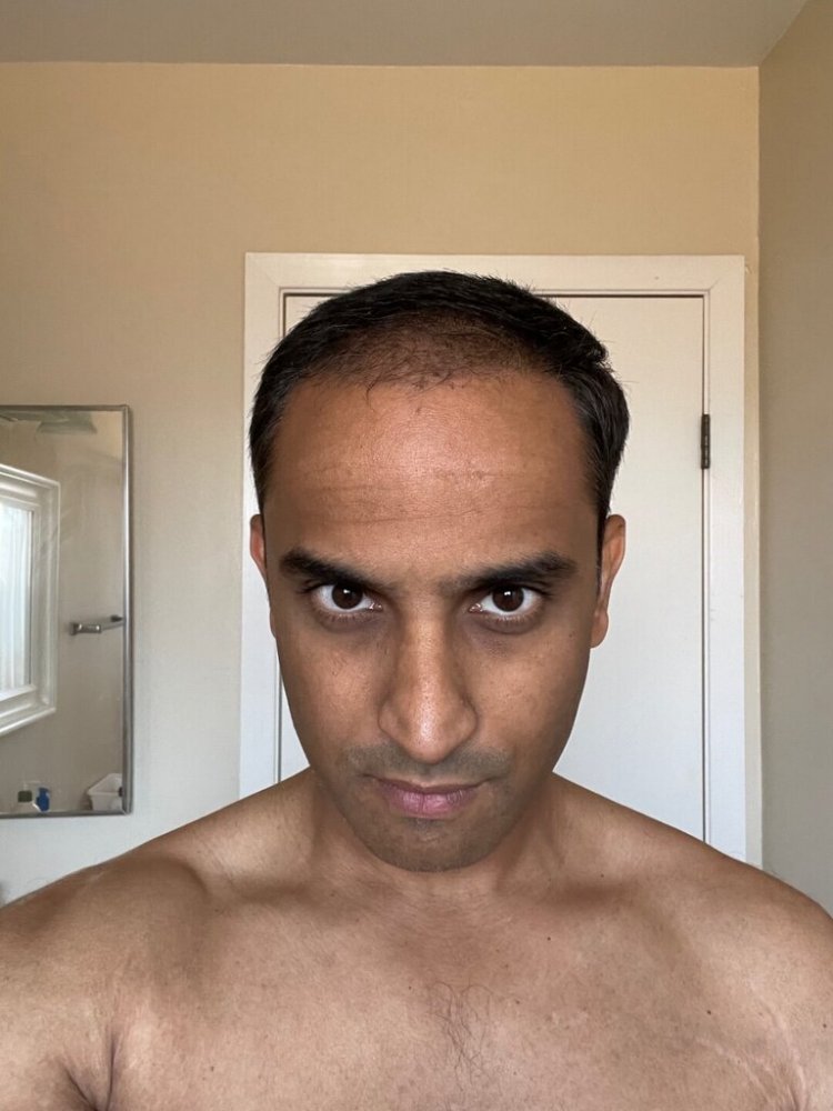 Dr. Ron Shapiro hair transplant10.jpeg