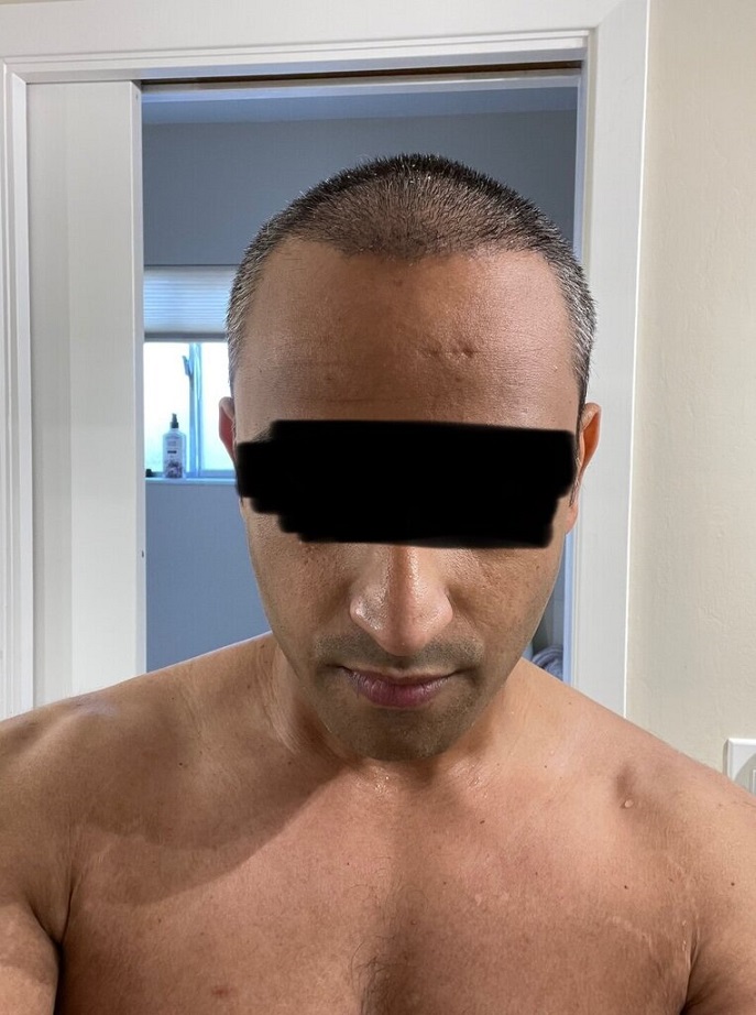 Dr. Ron Shapiro Hair Transplant11.jpeg