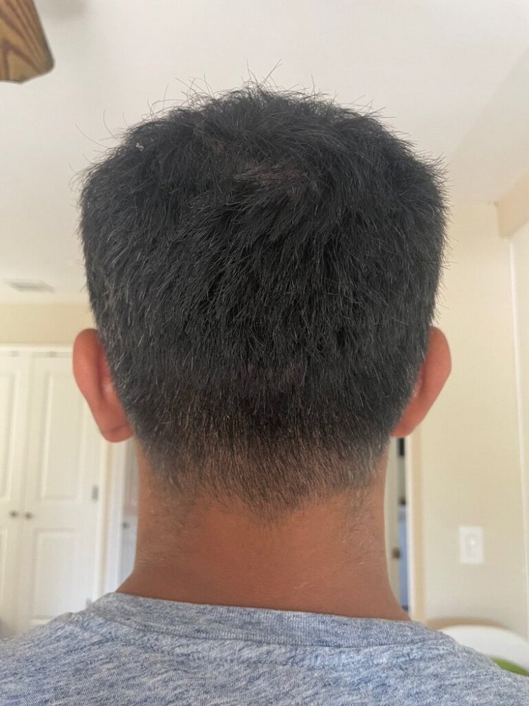 Dr. Ron Shapiro hair transplant11.jpeg