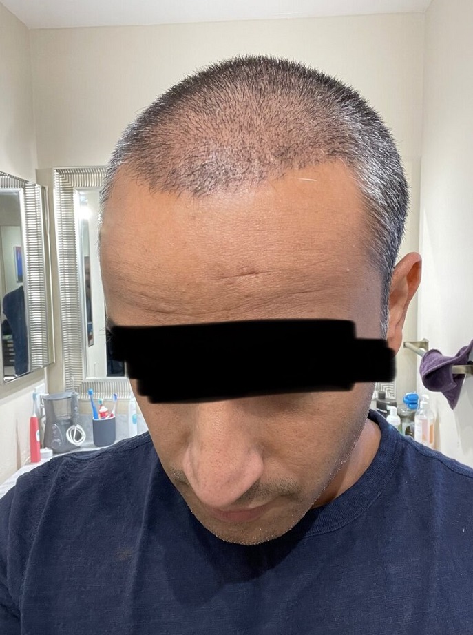 Dr. Ron Shapiro Hair Transplant12.jpeg