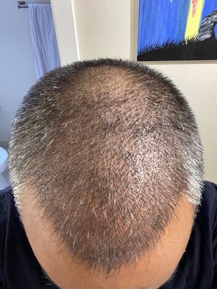 Dr. Ron Shapiro Hair Transplant13.jpeg