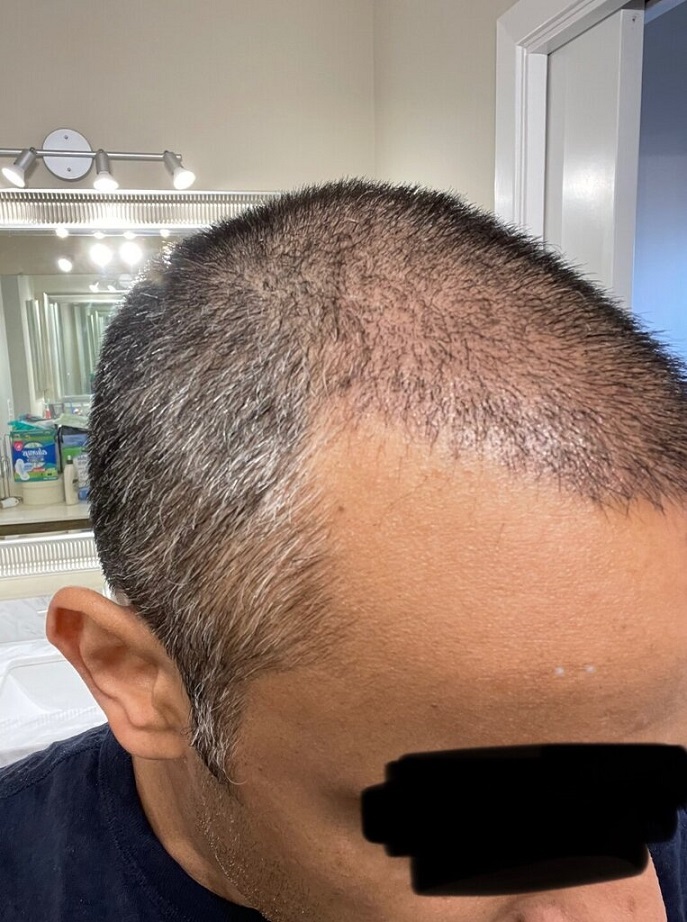 Dr. Ron Shapiro Hair Transplant14.jpeg