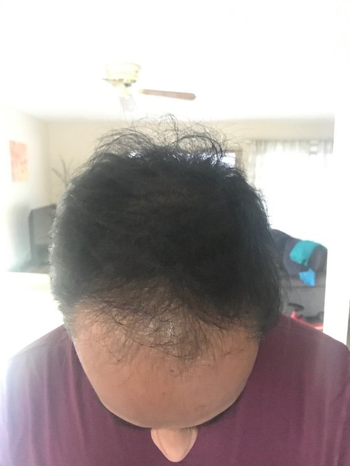Dr. Ron Shapiro Hair Transplant2.jpeg